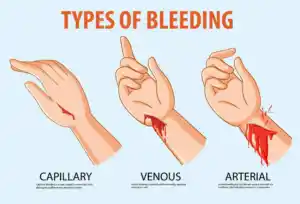 Types of bleeding